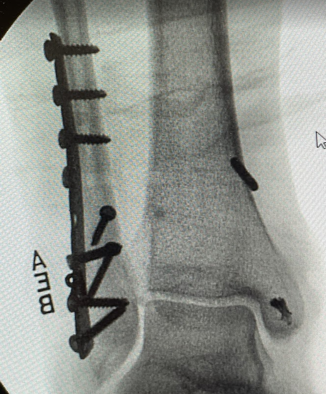 Picture of screws in leg